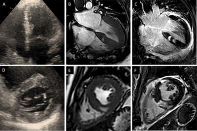 Case Report: Early Transplant Rejection of a Methanol-Intoxicated Donor Heart in a Young Female Patient. A Diagnostic Approach With CMR, Cardiac Biopsy, and Genetic Risk Assessment